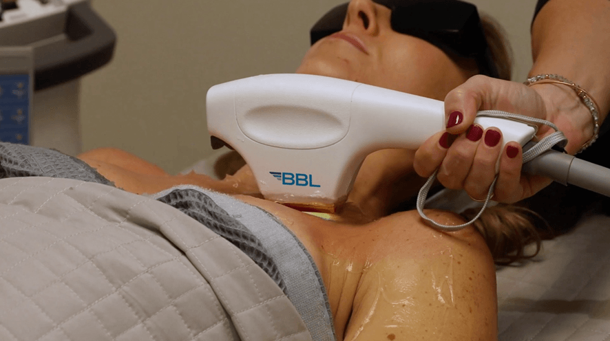 BBL® HERO™: The Fastest, Most Powerful IPL Joins NG Skin Clinic - ngskinclinic