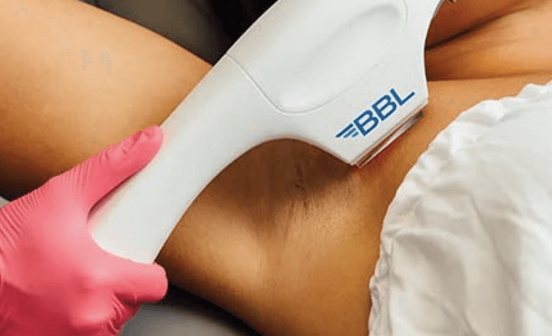 Staying Forever Young™ with BBL Hero: Our Christmas Miracle - NG Skin Clinic