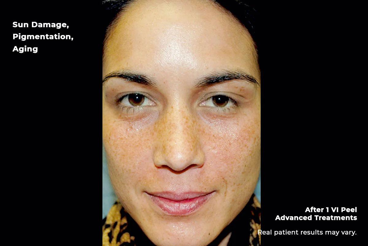 Advanced-4-before - ngskinclinic