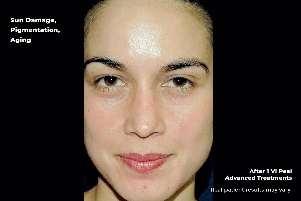 Advanced-4 - ngskinclinic