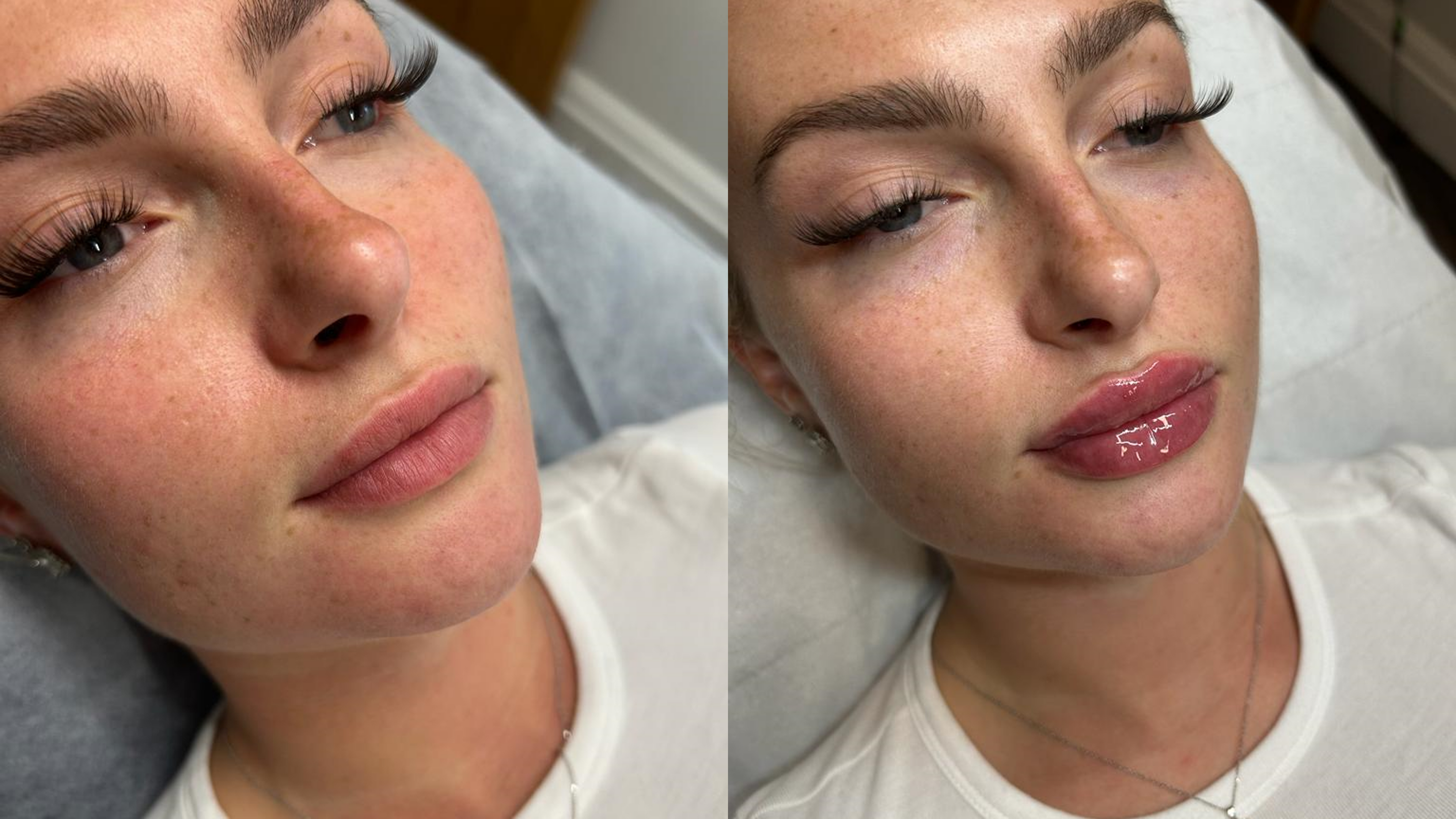 dermal filler ng skin clinic market harborough