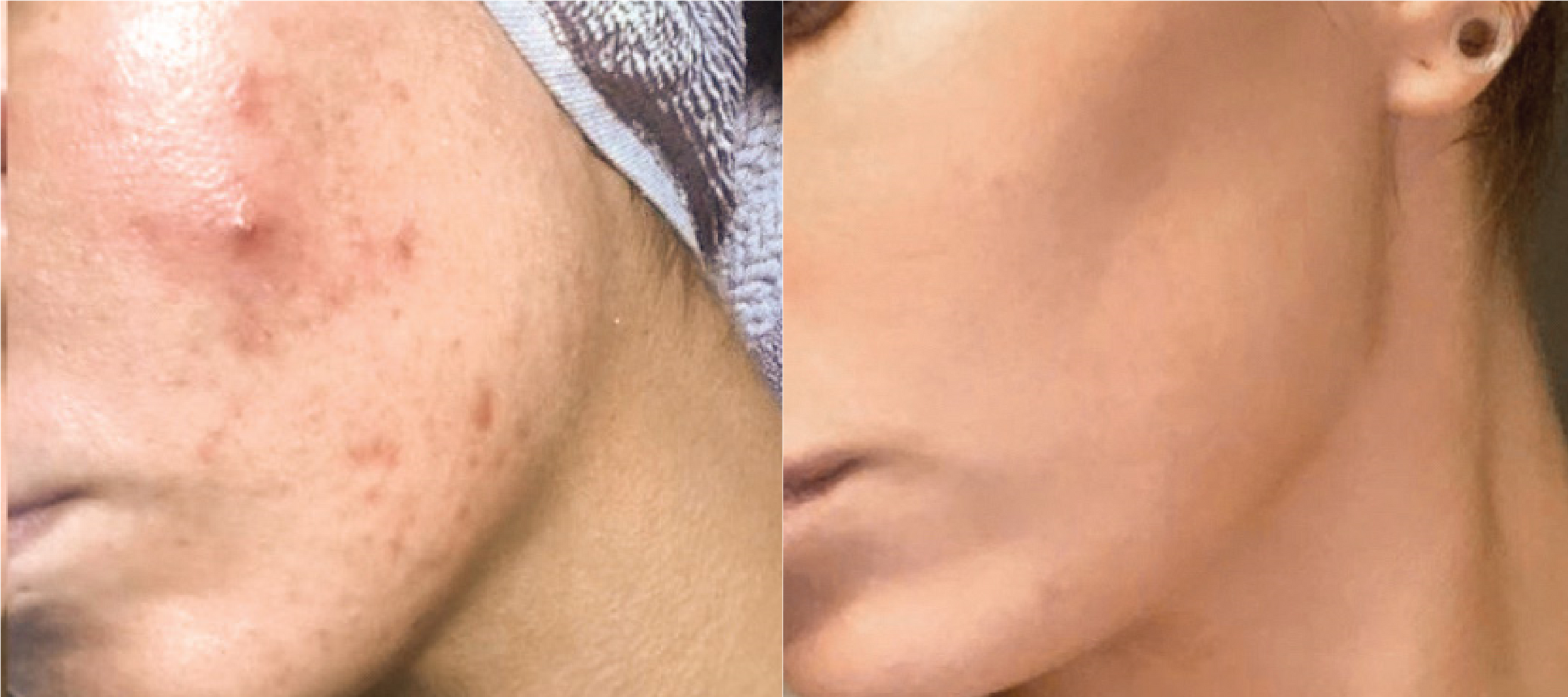 foreverclear bbl ng skin clinic2
