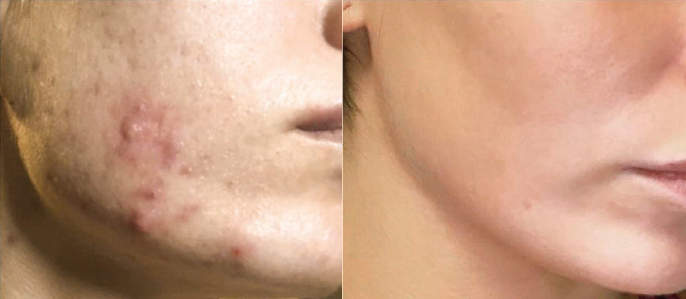 foreverclear bbl ng skin clinic3