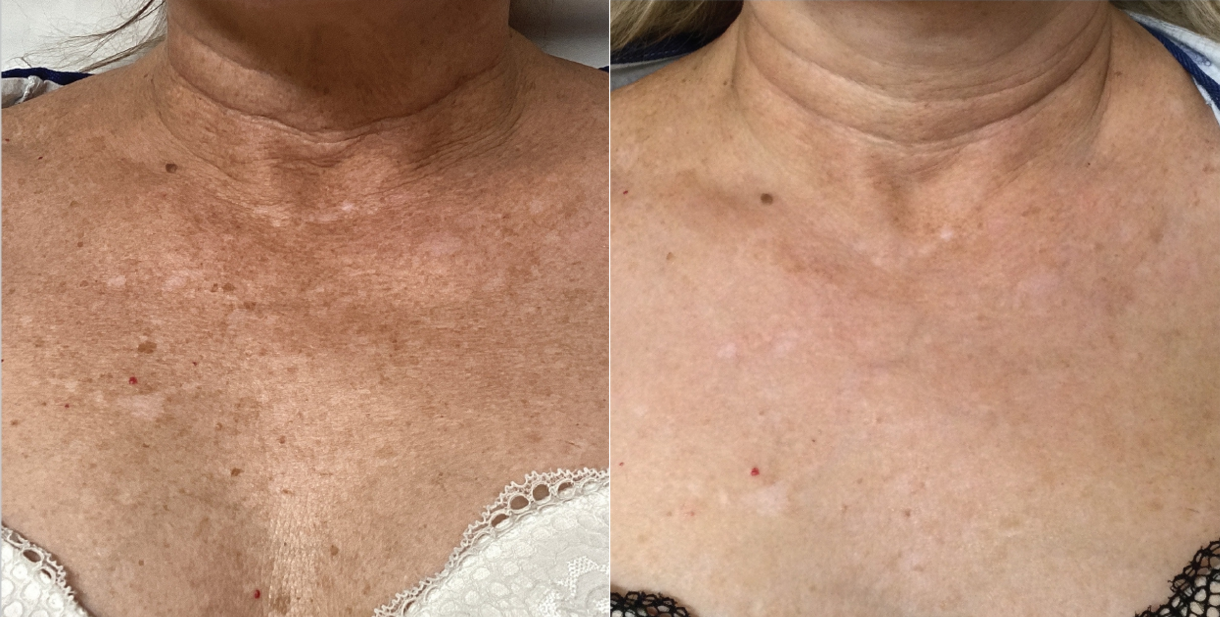 ng skin clinic bbl1
