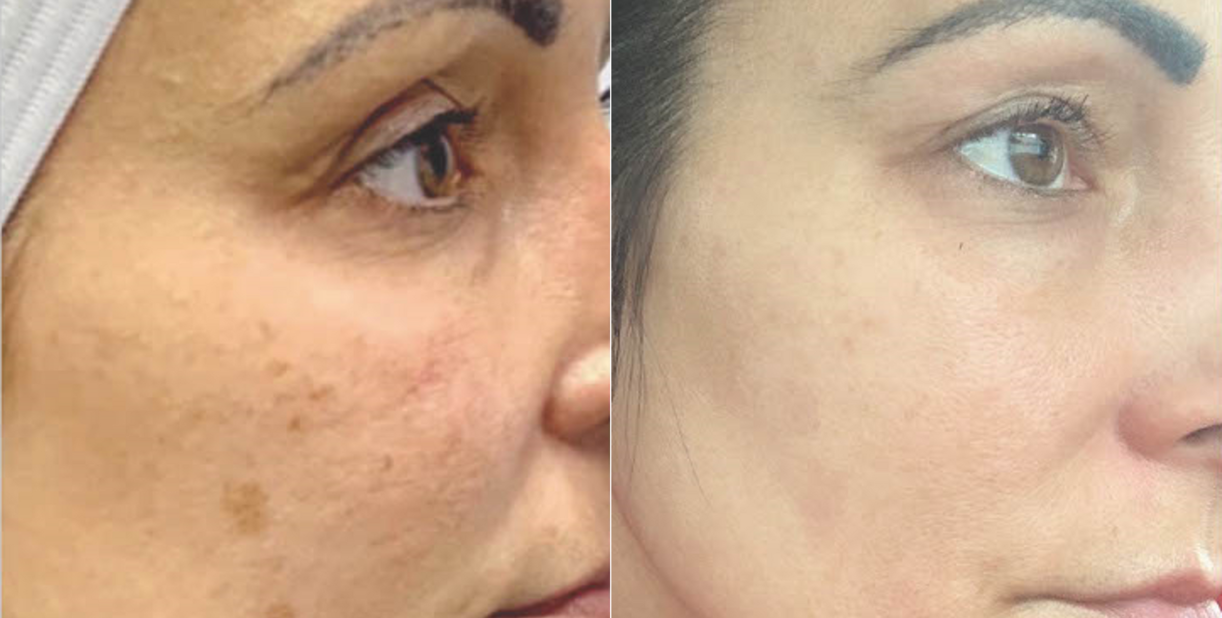 ng skin clinic bbl5