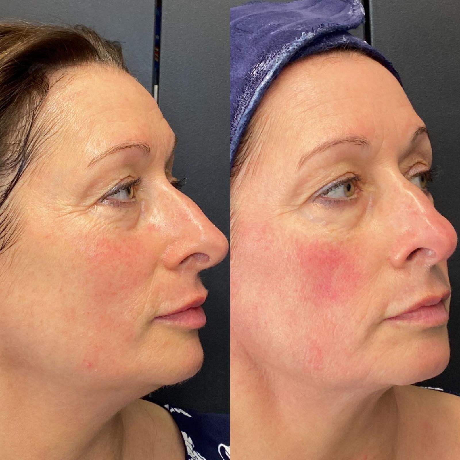 ng skin clinic collagen wave before after