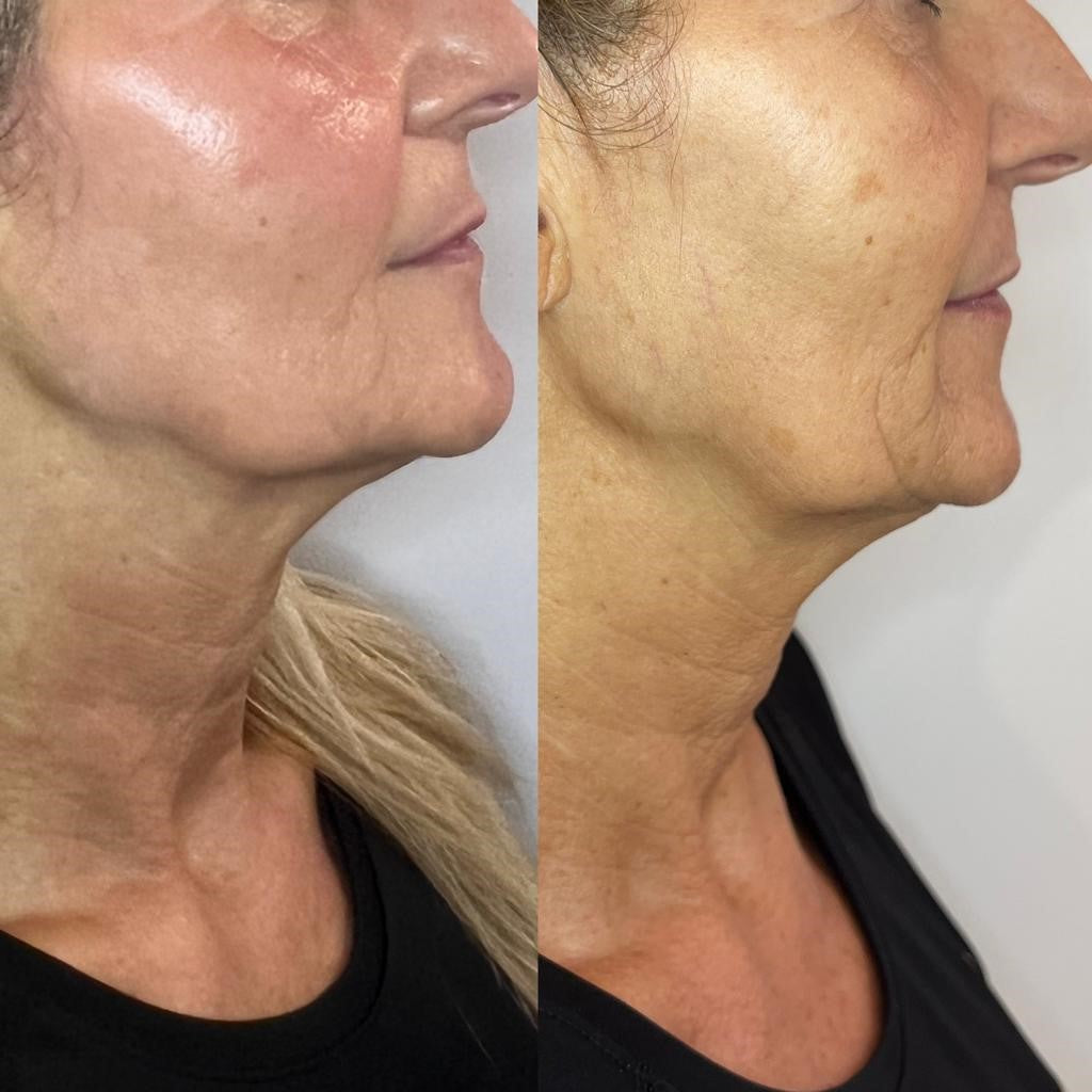 ng skin clinic collagen wave before after2