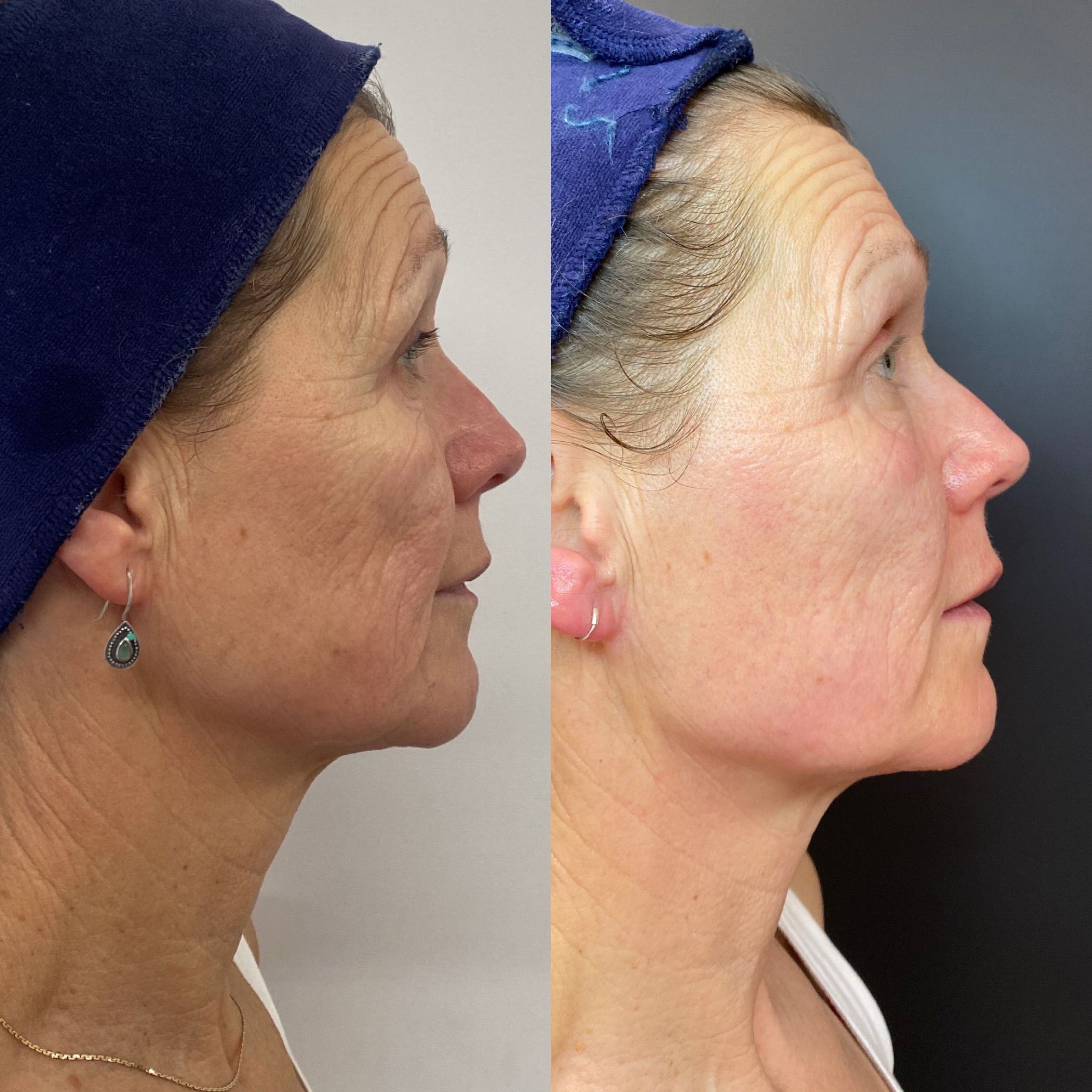 ng skin clinic collagen wave before after3